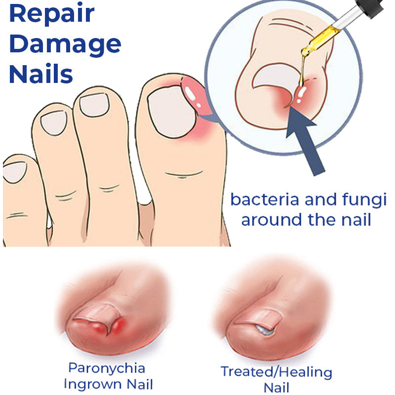 German ToenailCare™ Removal Paronychia Oil