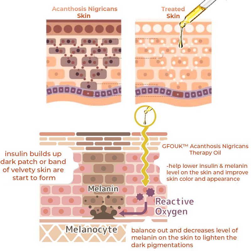 GFOUK™ Acanthosis Nigricans Therapy Oil