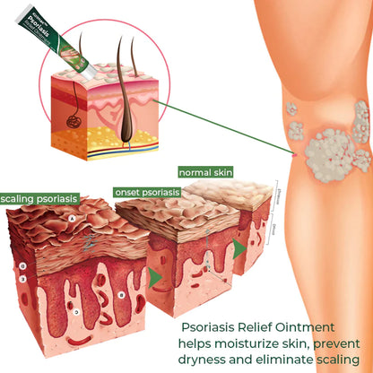 Kolmax™ Psoriasis Soothing Ointment